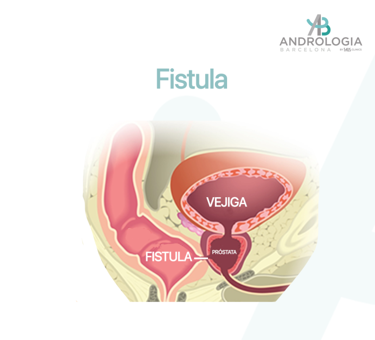 Imagen médica que muestra una fístula recto-prostática.