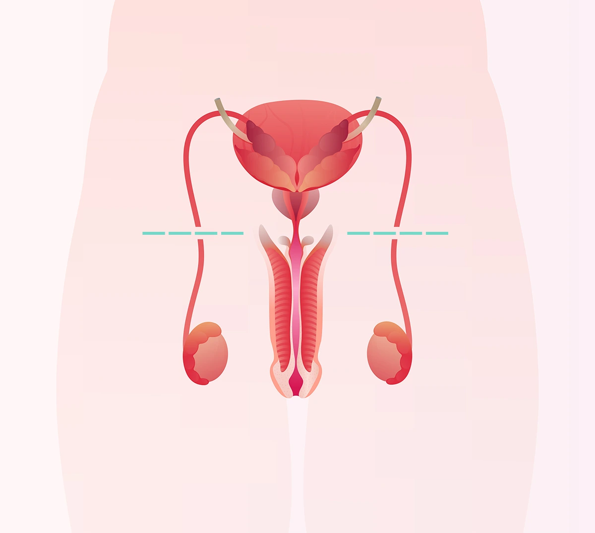 Vasectomía