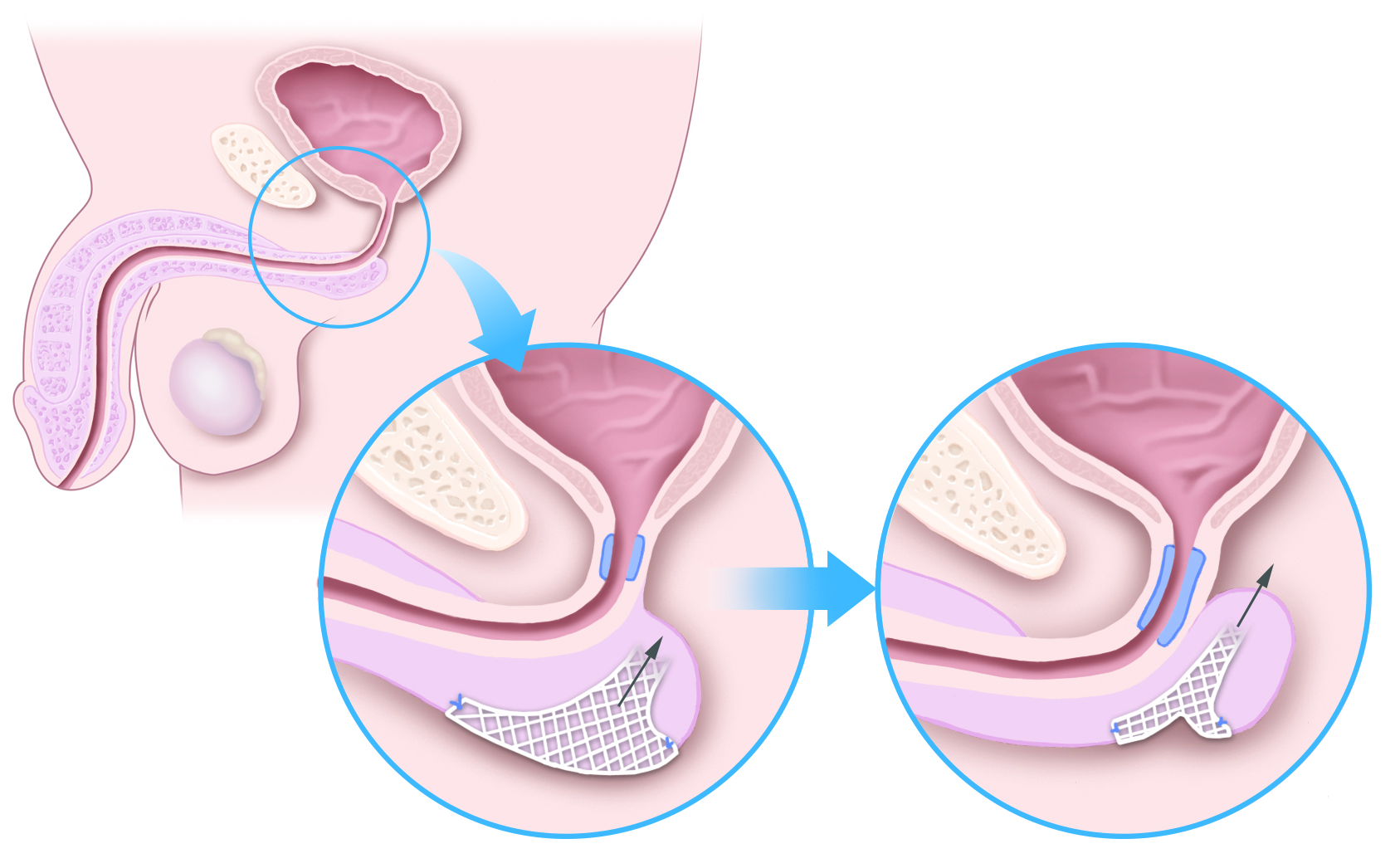 Este esquema ilustra el procedimiento de colocación de una malla suburetral para tratar la incontinencia urinaria masculina. La malla se coloca debajo de la uretra para proporcionar soporte y restaurar la continencia.