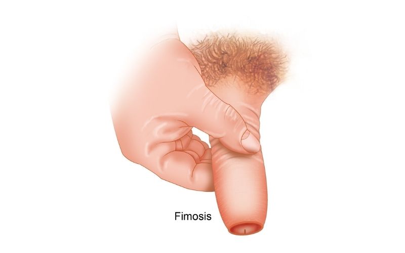 Pene con fimosis
