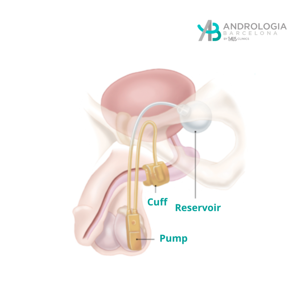 Diagram showing the components of the artificial urinary sphincter, including the inflatable cuff, pump, and saline reservoir.