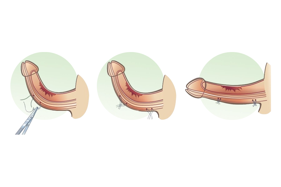 Corporoplastia tipo plicatura
