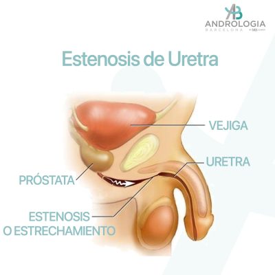 Imagen médica que ilustra estrechamiento o estenosis de la uretra.